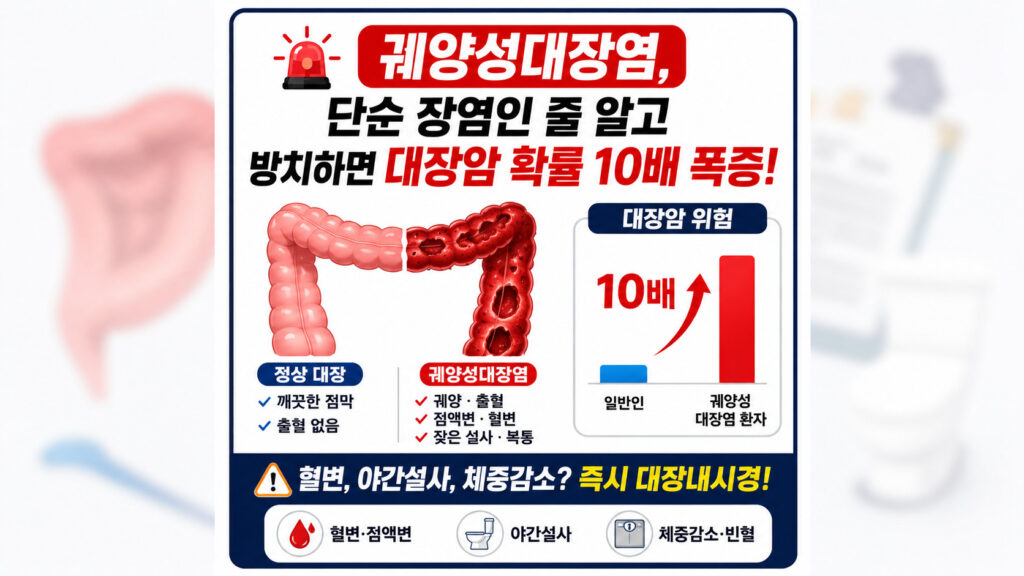 정상 대장과 궤양성 대장염 환자의 출혈 점막을 비교하고, 잦은 설사와 혈변 증상을 방치할 경우 대장암 발병 확률이 10배 폭증한다는 사실을 경고하는 인포그래픽⁠