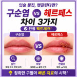 구순염 헤르페스 차이 원인 모양 전염성 비교 인포그래픽